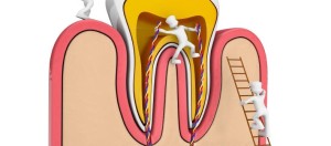 root-canal-790x350